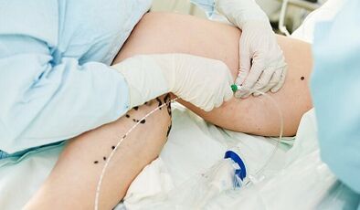 Metody leczenia żylaków na nogach u kobiet