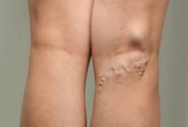 Diagnostyka żylaków u kobiet w ciąży