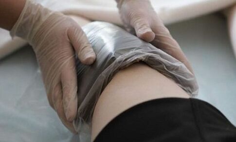 leczenie żylaków za pomocą okładów