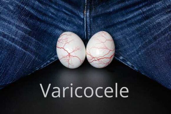 Varicocele - rozszerzenie żył powrózka nasiennego